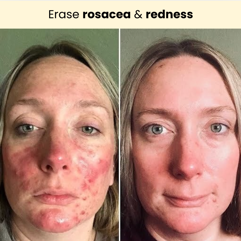 Kojic Acid Turmeric Overnight Mask For Rosacea