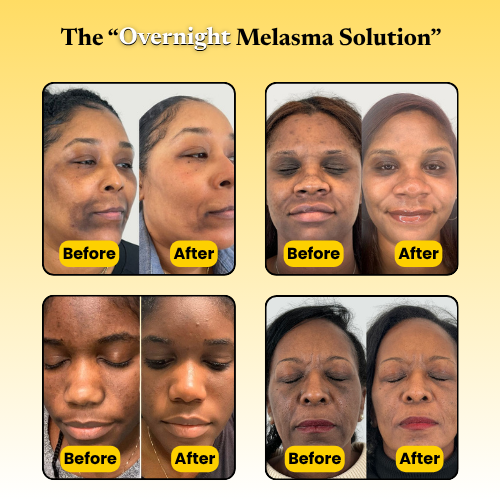 Kojic Acid Turmeric Overnight Mask For Melasma
