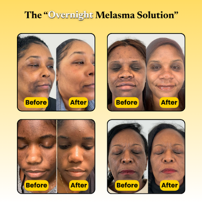 Kojic Acid Turmeric Overnight Mask For Melasma