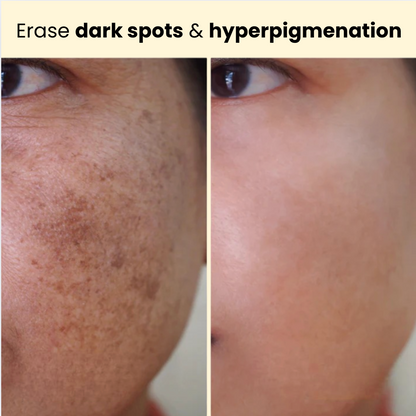 Kojic Acid Turmeric Overnight Mask For Acne Scars