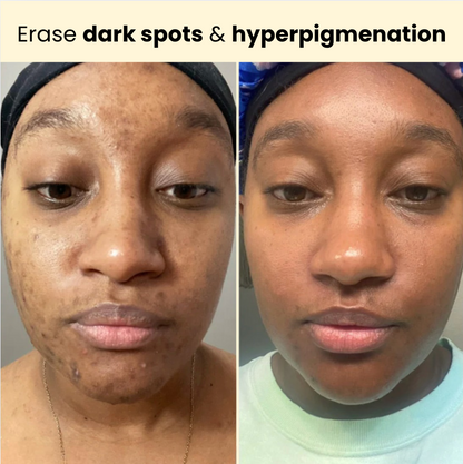 Kojic Acid Turmeric Overnight Mask