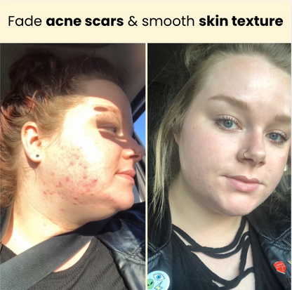 Kojic Acid Turmeric Overnight Mask For Rosacea