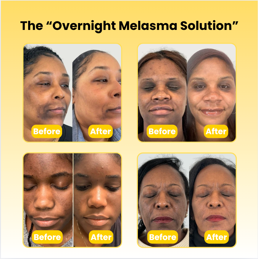 Kojic Acid Turmeric Overnight Mask For Melasma